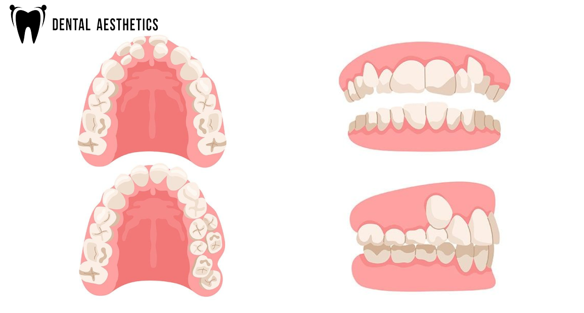 What Is Hyperdontia